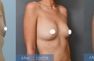 療程效果因人而異，上圖為A罩杯女性在做完自體脂肪隆乳之後手術後一年六個月、手術後一年十個月之成效